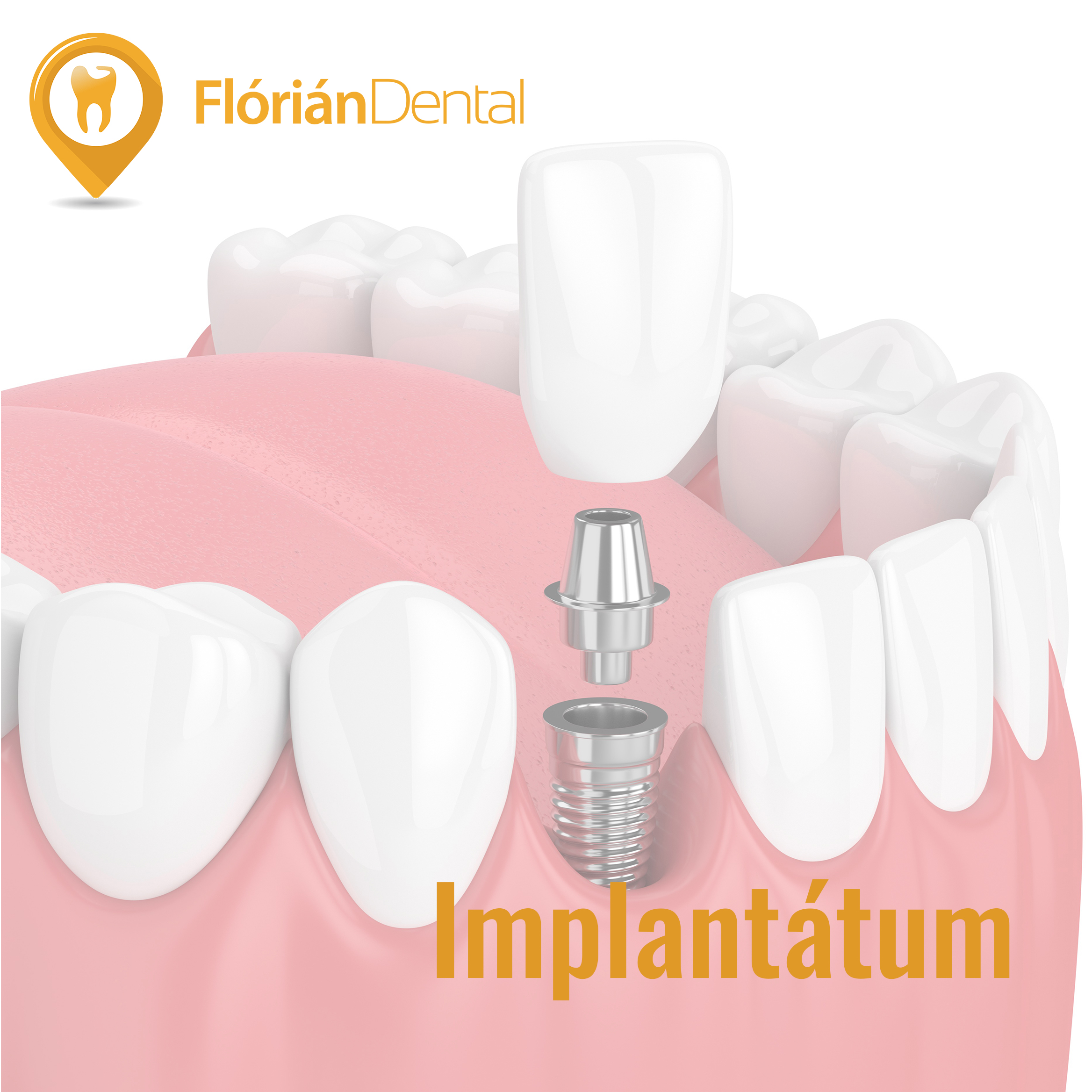 Fog implant tum Fl ri n Dental Fog szat Budapest